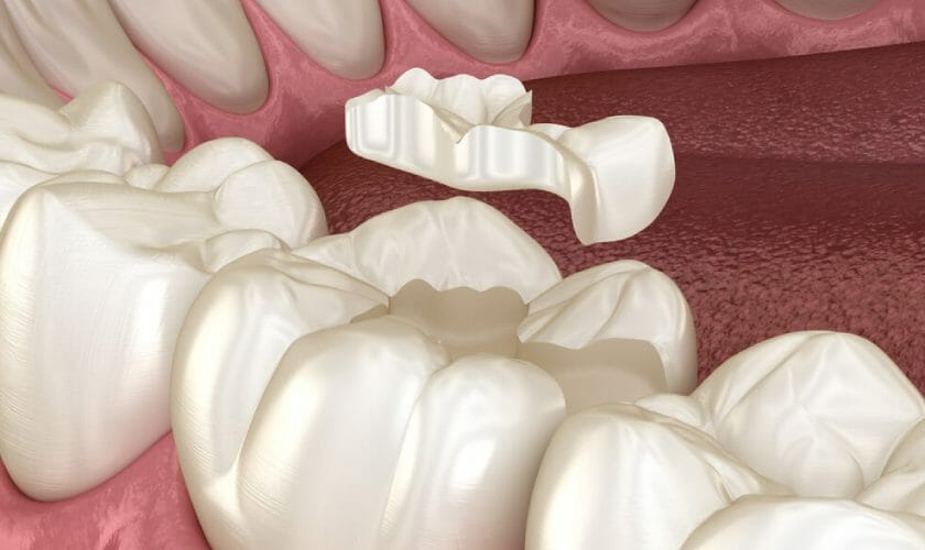 Cavities and Fillings