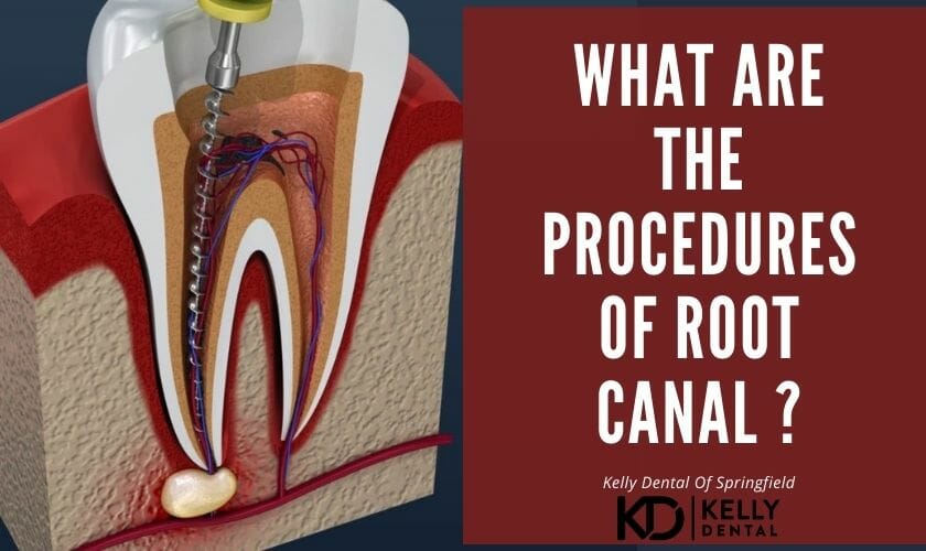 What Are The Procedures Of Root Canal