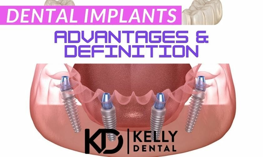 Dental Implants Springfield