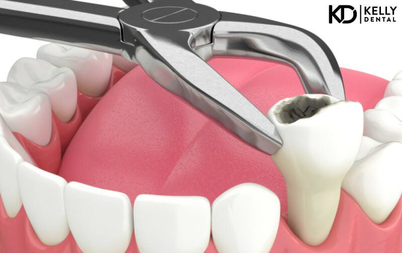 Tooth Extraction in Springfield