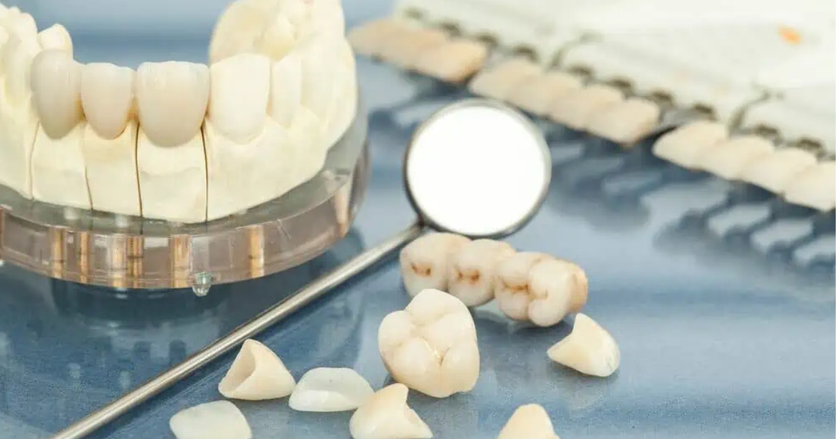The Longevity Of Your Smile: Maintaining Dental Crowns And Veneers