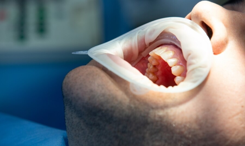 how long does gum surgery take to heal