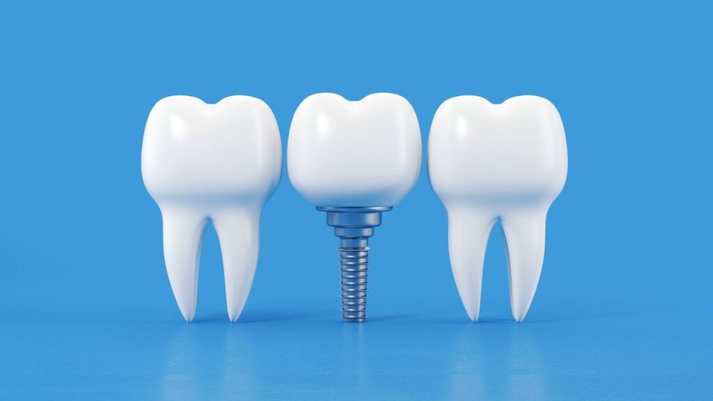 7 amazing benefits of dental implants