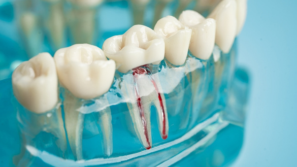 how to keep your tooth healthy after a root canal