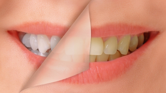 the impact of pH levels in foods on teeth whitening