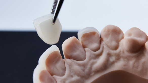 how long your dental crowns last