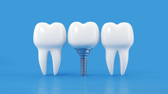 address the common misconceptions people have about dental implants