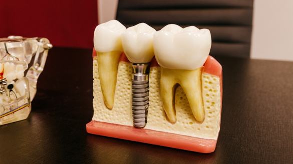 things you must avoid before getting dental implants