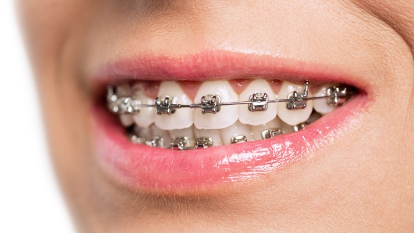the benefits of getting braces as an adult