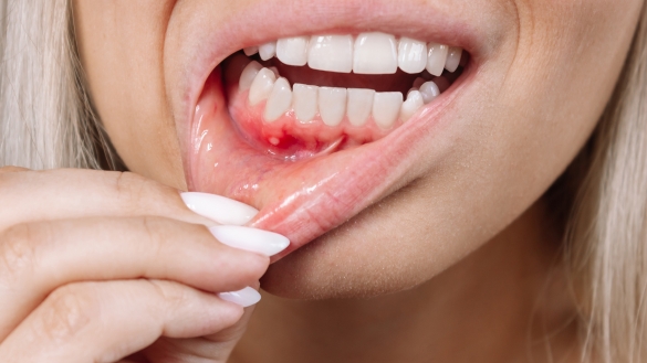 why you should never delay treatment for gum disease