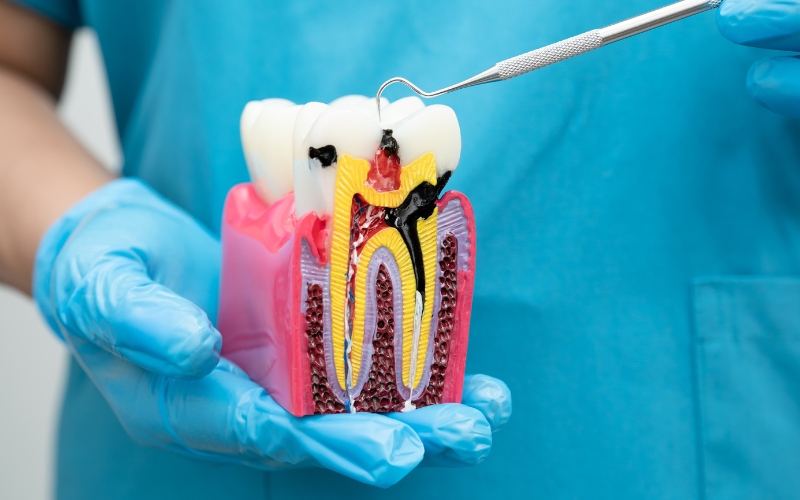 root canal save tooth
