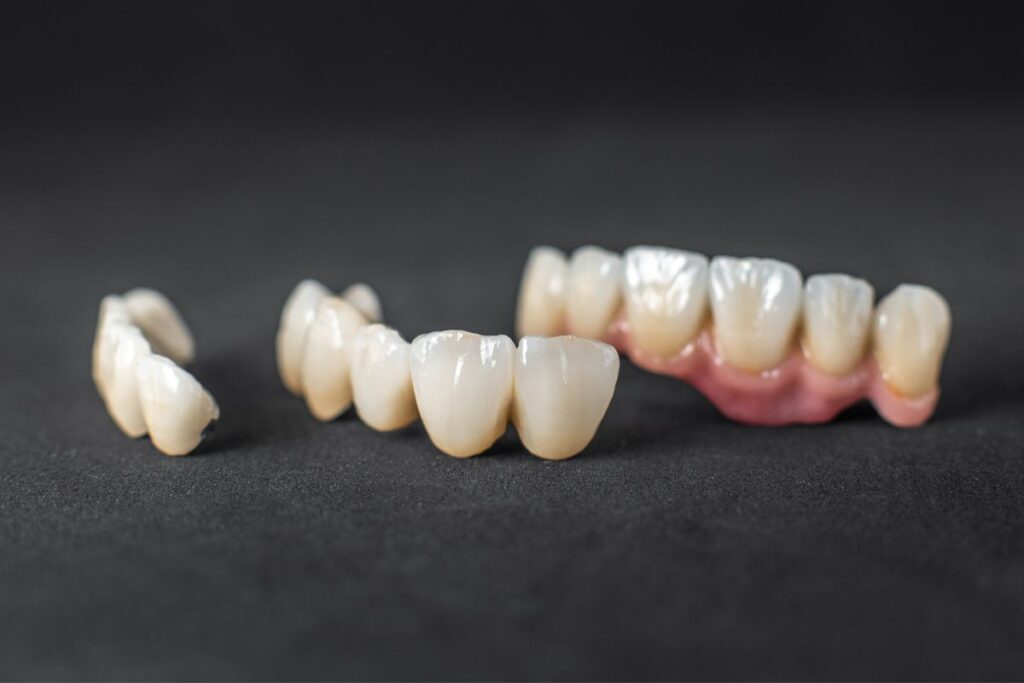Can Dental Veneers Fix Gaps and Uneven Teeth Without Braces?