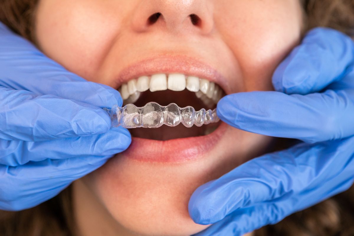 How Often Should You Change Invisalign Trays for Best Results?