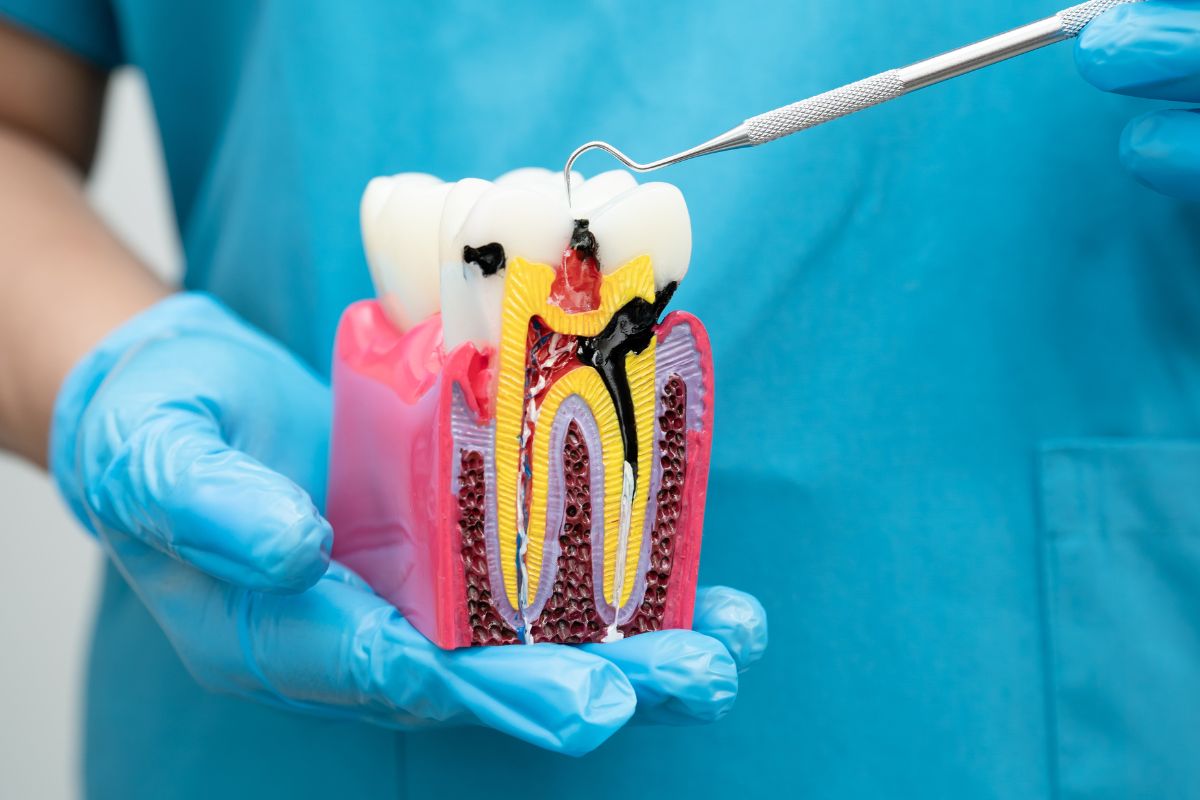 How Long Does a Root Canal Last Before Retreatment?