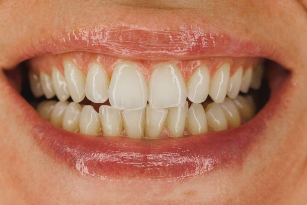 How Do You Choose the Right Dental Crown Material for Your Teeth?