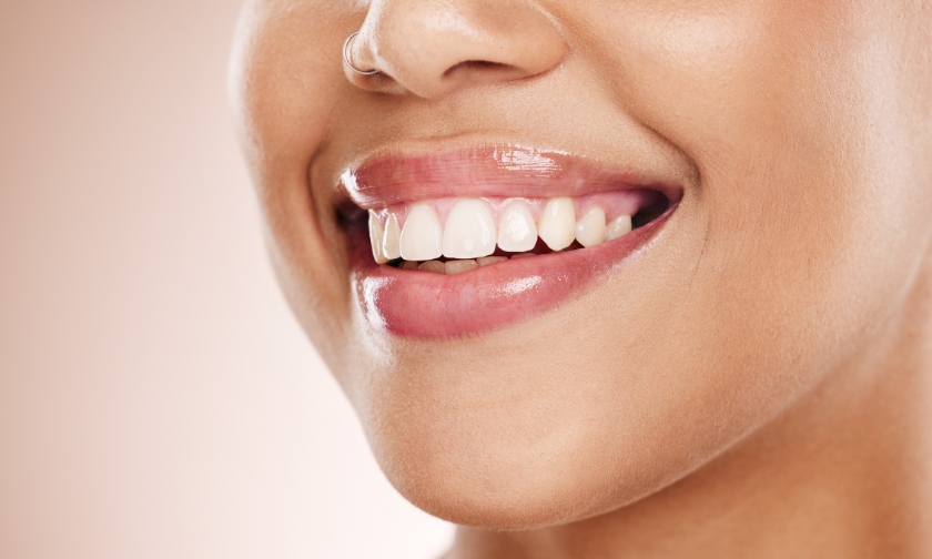 teeth whitening springfield, mo