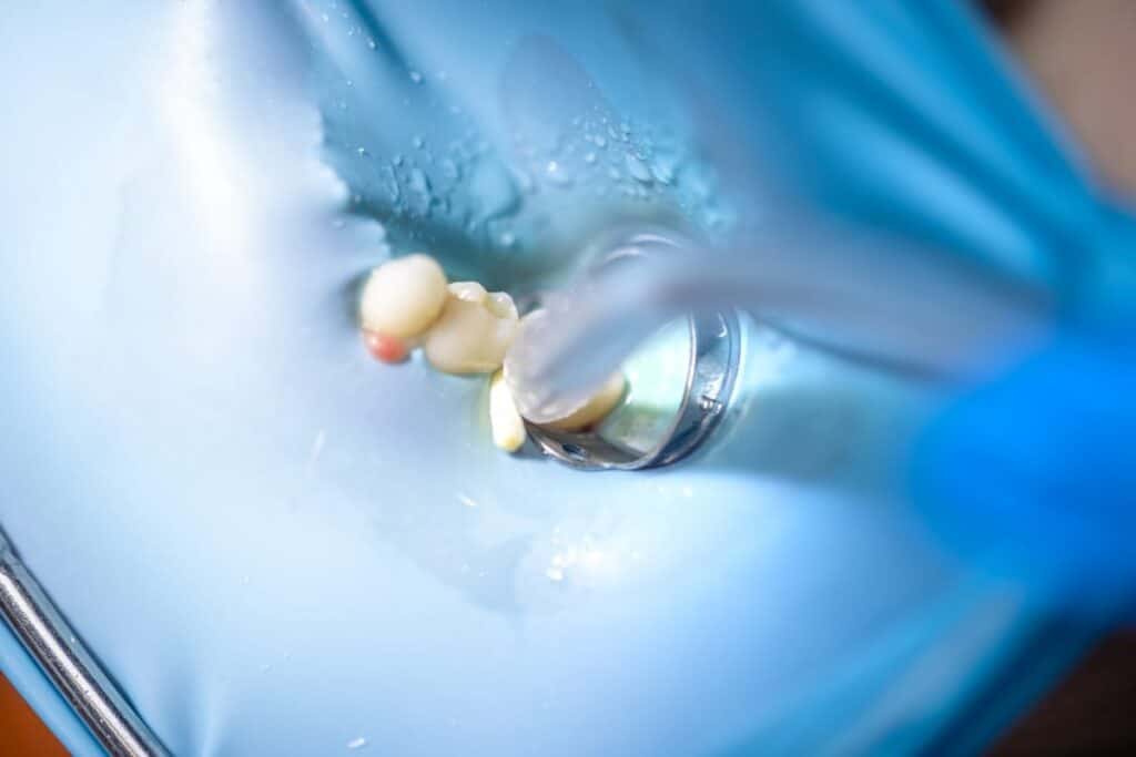 Root Canal Treatment in Springfield