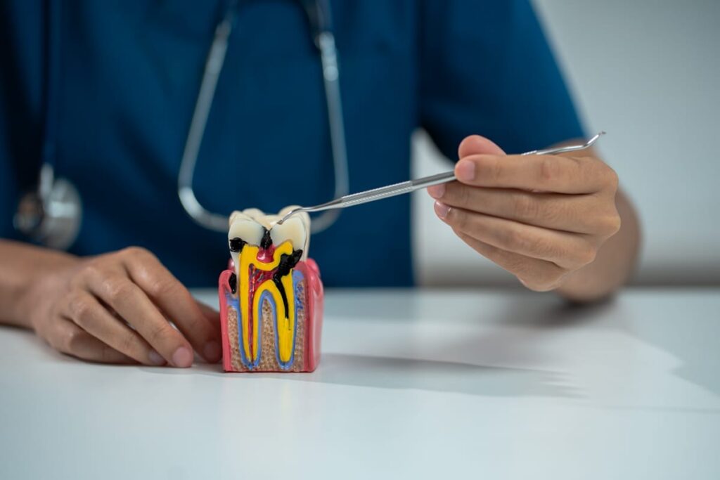 Root Canal Treatment in Springfield