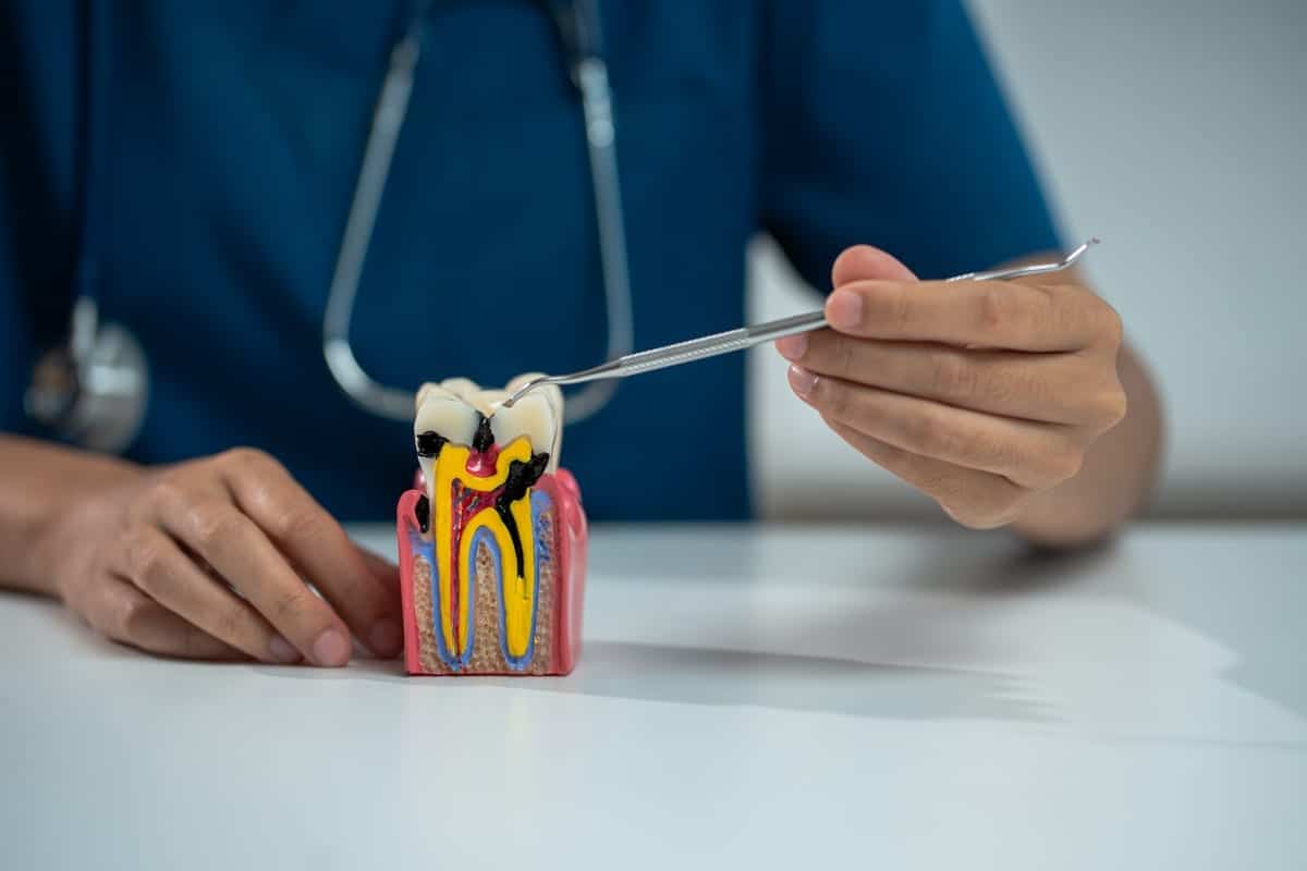 Root Canal Treatment in Springfield