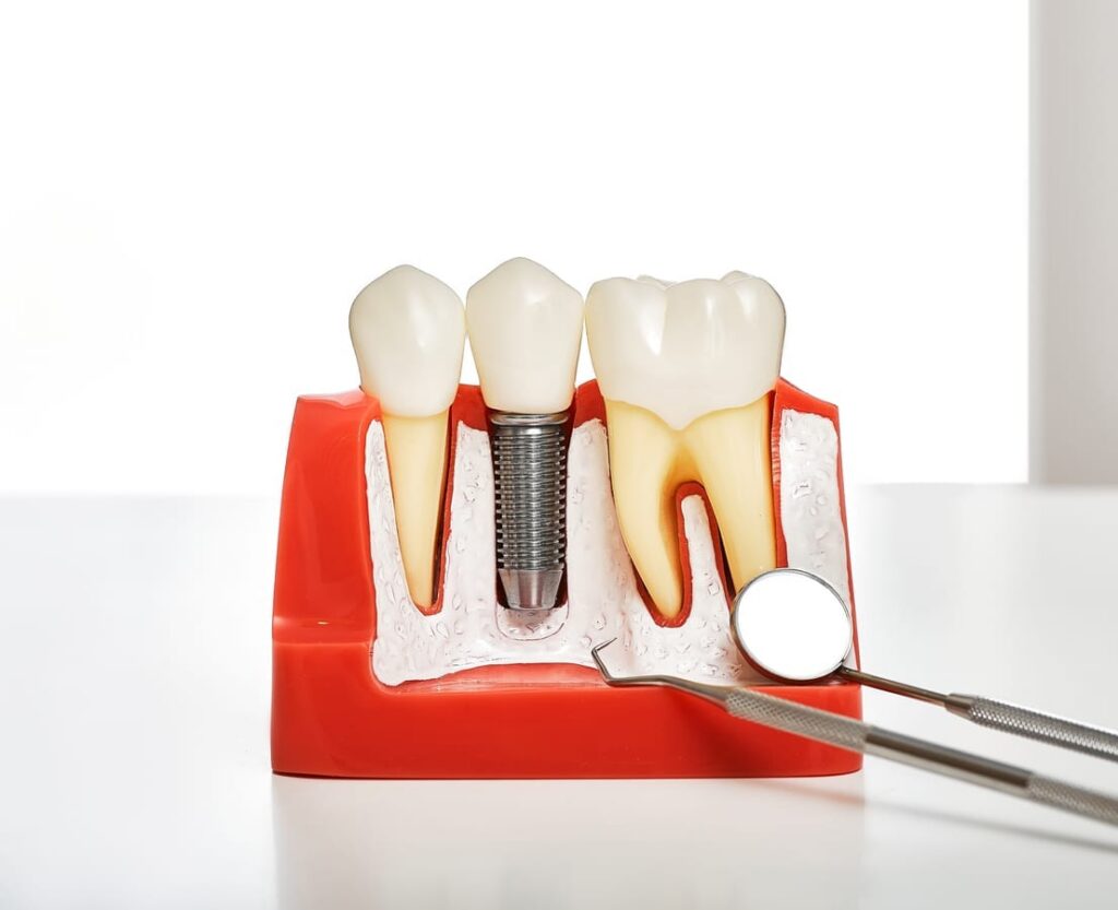 Dental Implant Recovery in Springfield