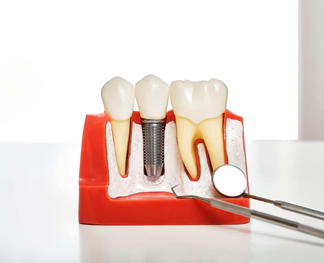 Dental Implant Recovery in Springfield