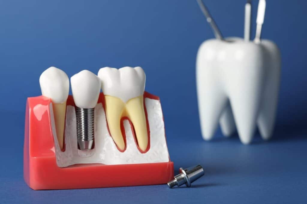 Implant Supported Dentures in Springfield