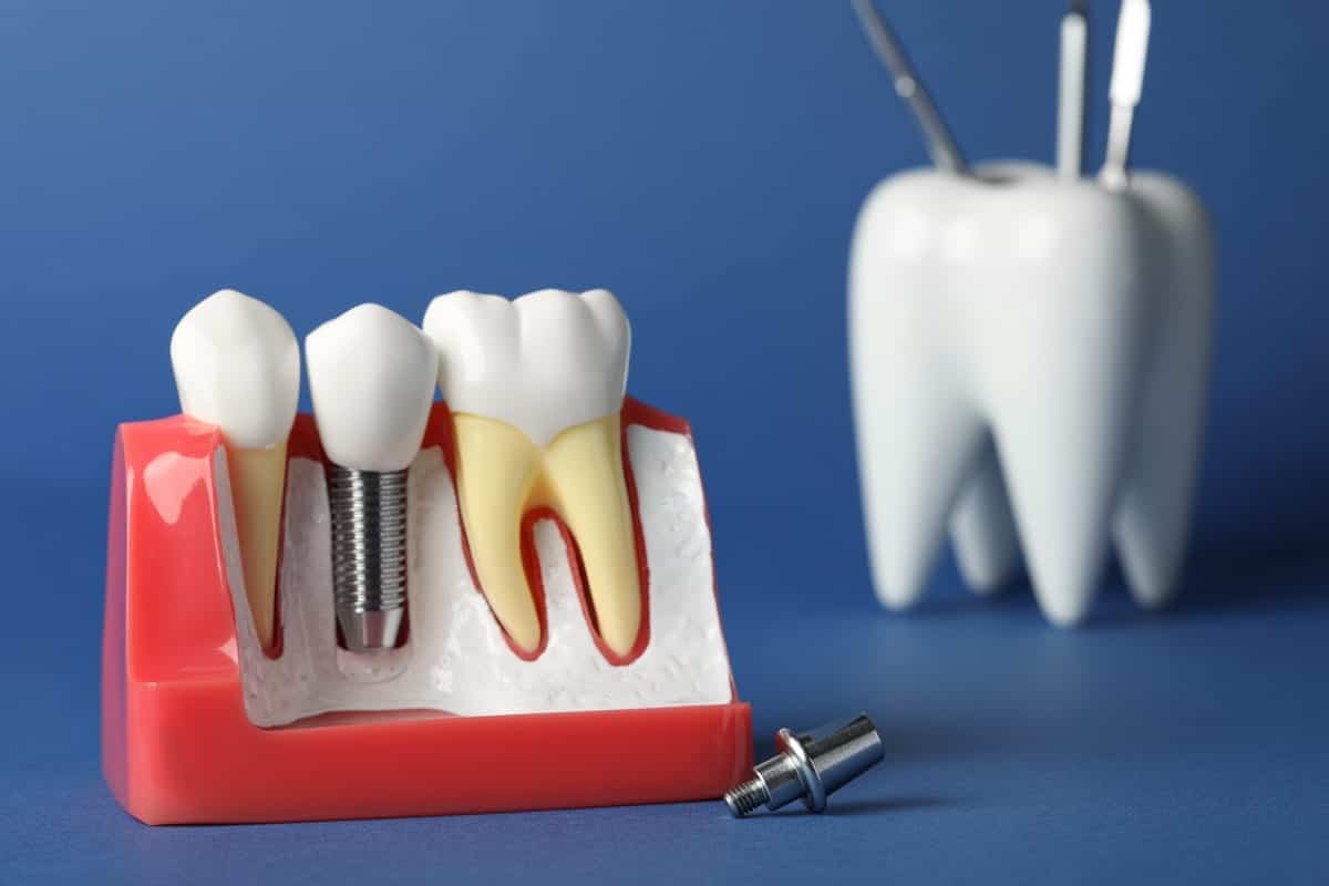 Implant Supported Dentures in Springfield