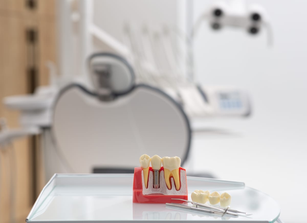 Implants vs Dentures in Springfield