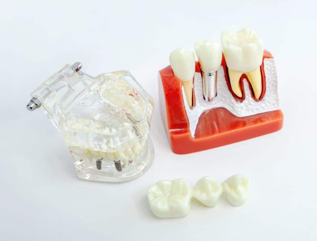All-on-4 Dental Implants in Springfield