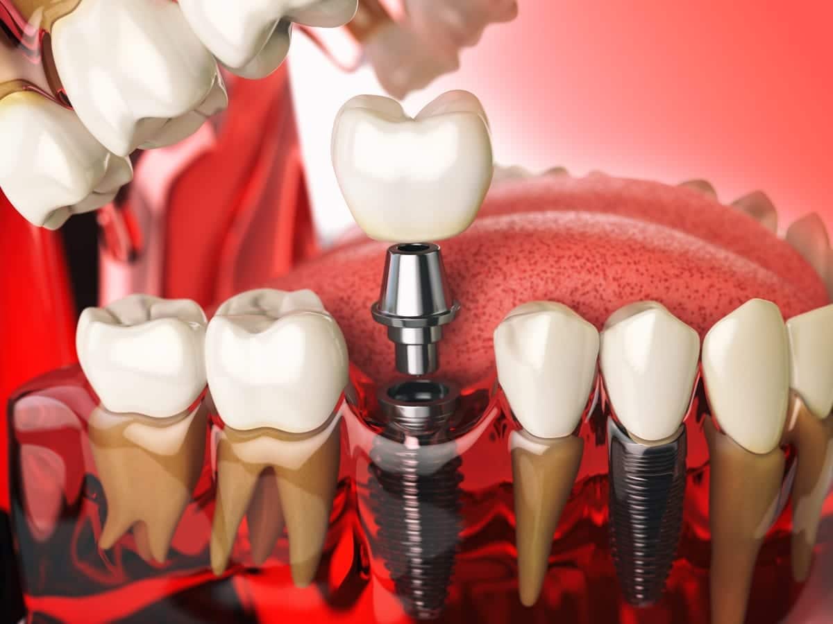 Dental Implants in Springfield