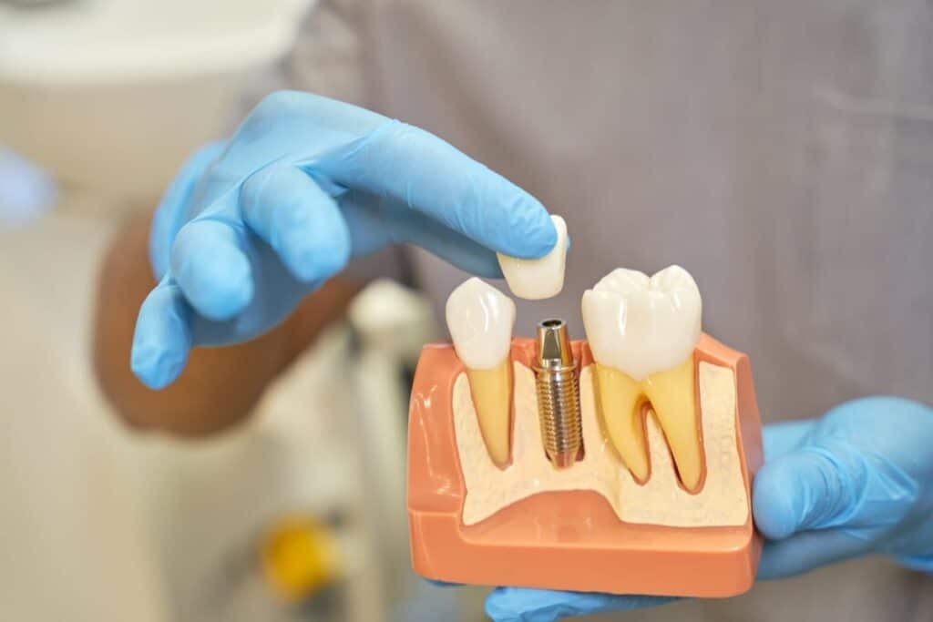 Implants vs Dentures in Springfield